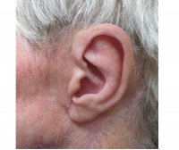 Auricular external cosmetic prosthesis / adult