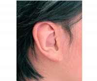 Auricular external cosmetic prosthesis / partial / adult