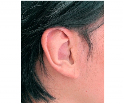 Auricular external cosmetic prosthesis / partial / adult