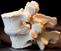 Degenerative Spondylolisthesis