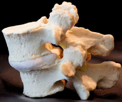 Degenerative Spondylolisthesis