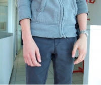 Hand external cosmetic prosthesis / adult