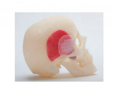 ST Temporalis™