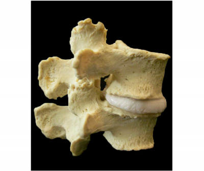 Stenosis