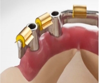 Straumann® CARES®